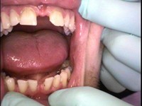 Protetska sanacija ortodontske anomalije