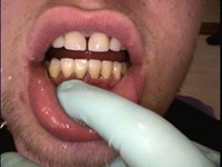 Protetska sanacija ortodontske anomalije